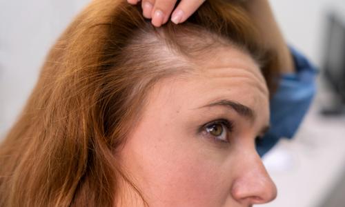 Understanding Telogen Effluvium (TE) and Hair Shedding