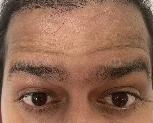 Before and after result 11