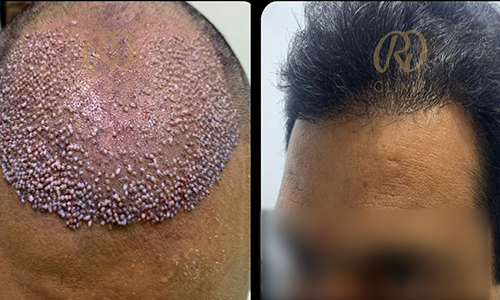 Before and after result 4