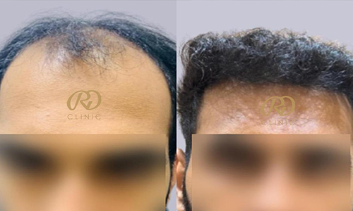 Before and after result 6