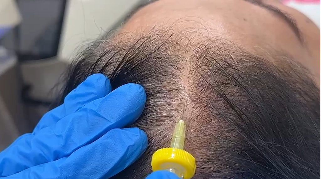 Follicular Oâ‚‚ Boost Therapy at RD Clinic