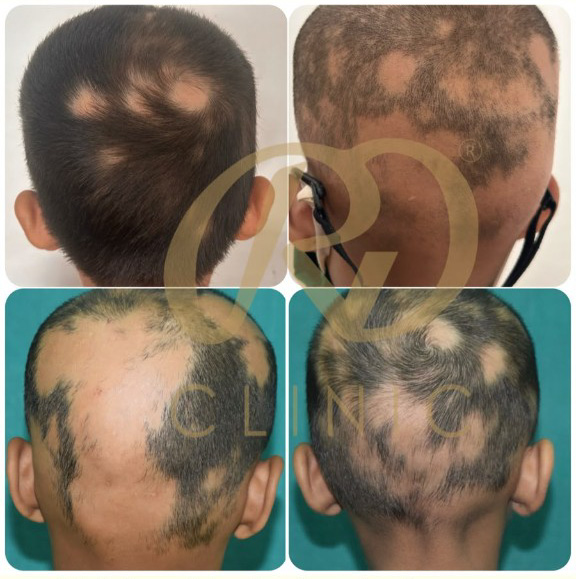 Paediatric Hair Loss
