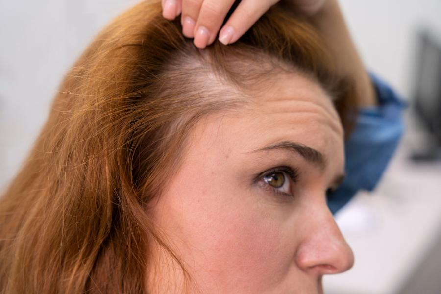 Telogen Effluvium and Excessive Shedding