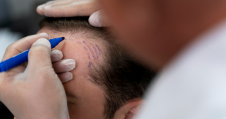 Hair Transplant Evaluation and Correction